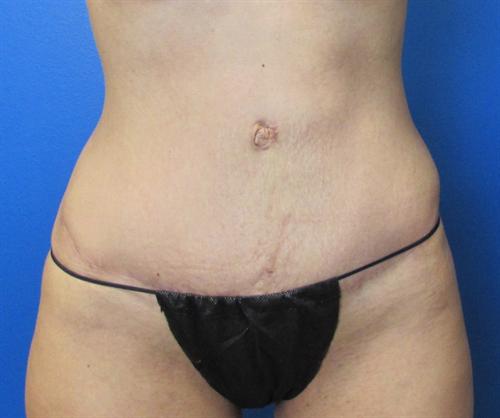 Tummy Tuck Before and After | SGK Plastic Surgery