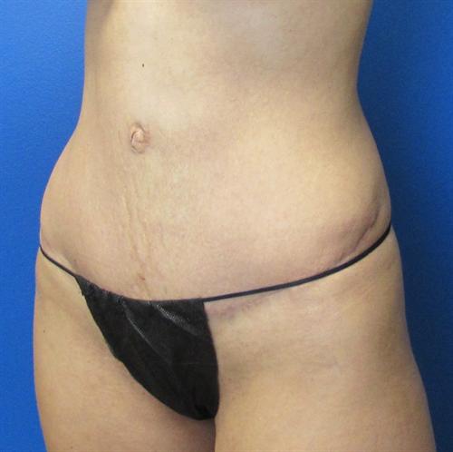 Tummy Tuck Before and After | SGK Plastic Surgery