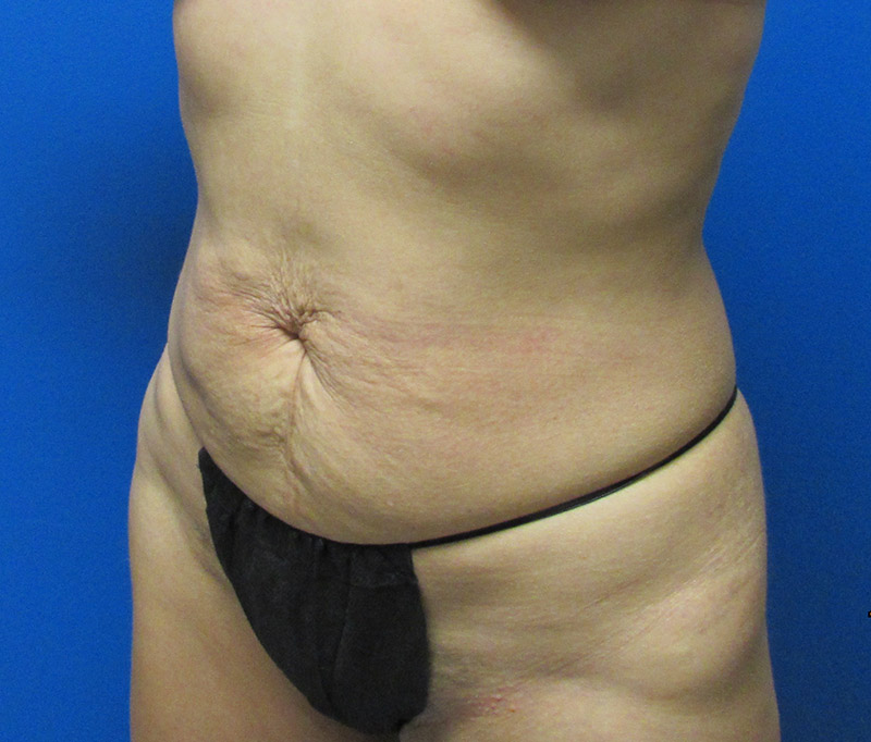 Tummy Tuck Before and After | SGK Plastic Surgery