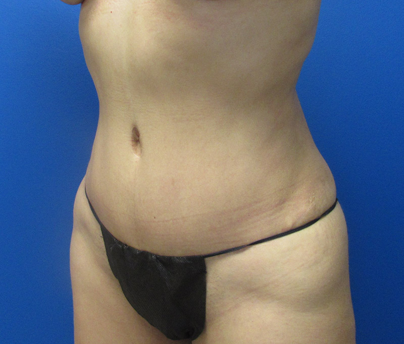 Tummy Tuck Before and After | SGK Plastic Surgery