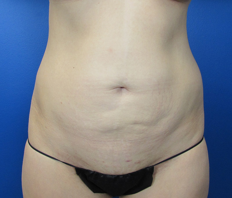 Tummy Tuck Before and After | SGK Plastic Surgery