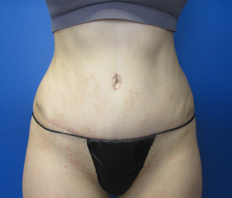 Tummy Tuck Before and After | SGK Plastic Surgery