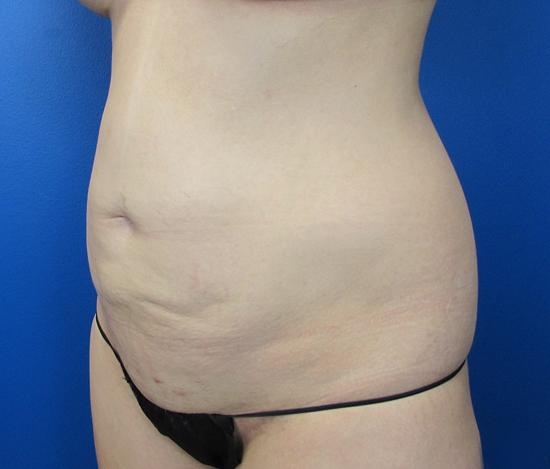 Tummy Tuck Before and After | SGK Plastic Surgery