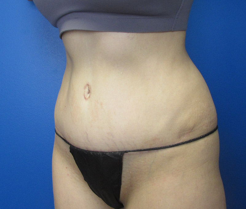 Tummy Tuck Before and After | SGK Plastic Surgery