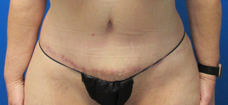 Tummy Tuck Before and After | SGK Plastic Surgery