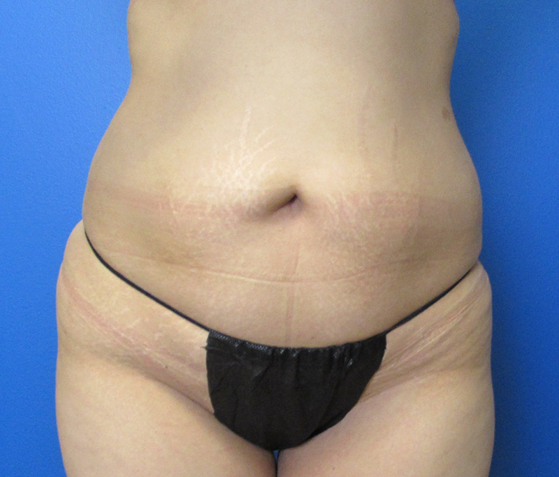 Tummy Tuck Before and After | SGK Plastic Surgery