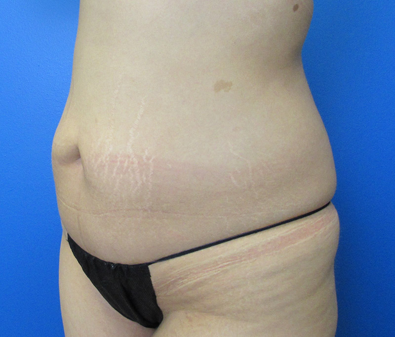 Tummy Tuck Before and After | SGK Plastic Surgery