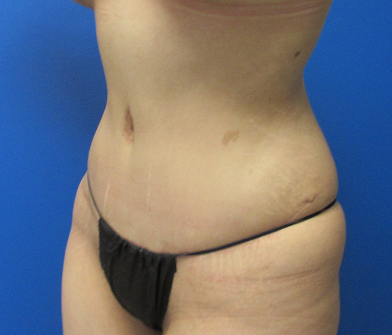 Tummy Tuck Before and After | SGK Plastic Surgery