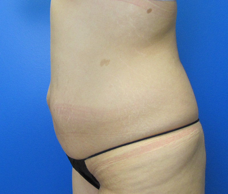 Tummy Tuck Before and After | SGK Plastic Surgery