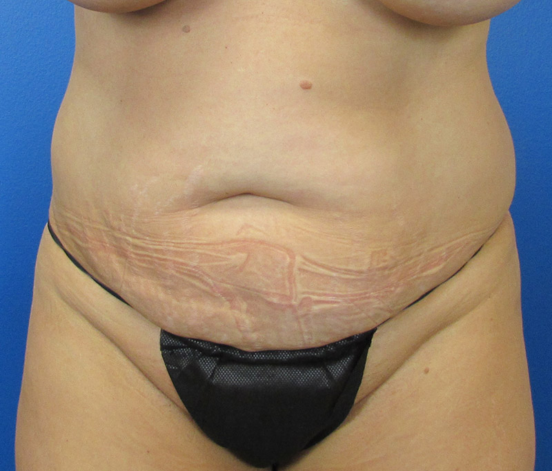 Tummy Tuck Before and After | SGK Plastic Surgery