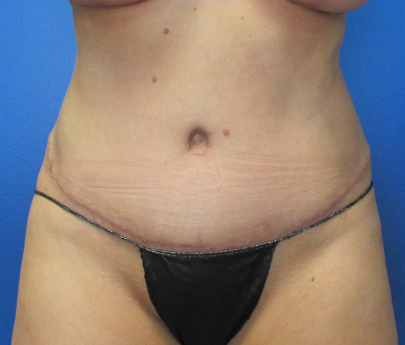 Tummy Tuck Before and After | SGK Plastic Surgery