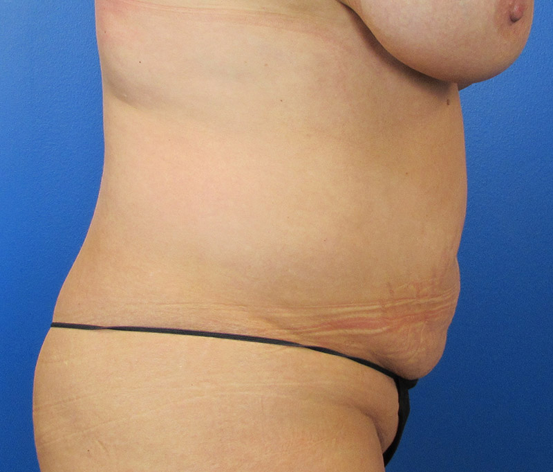 Tummy Tuck Before and After | SGK Plastic Surgery