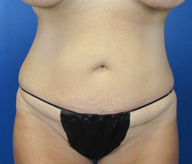 Tummy Tuck Before and After | SGK Plastic Surgery