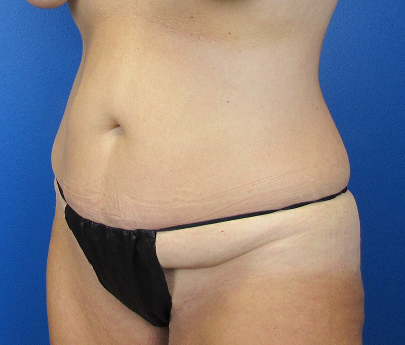 Tummy Tuck Before and After | SGK Plastic Surgery