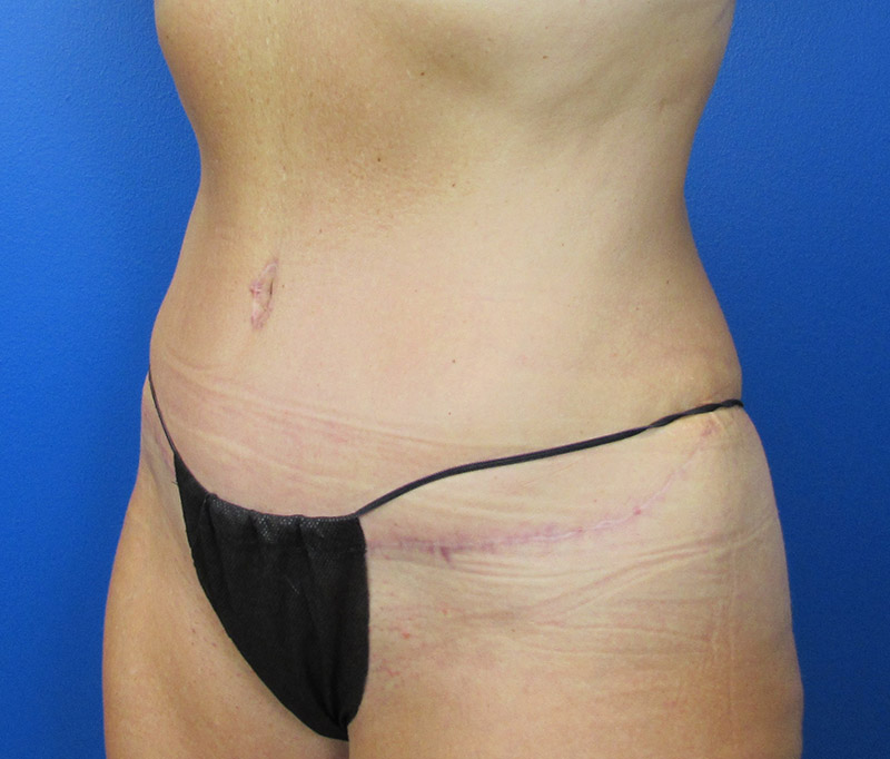 Tummy Tuck Before and After | SGK Plastic Surgery