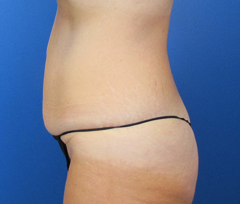 Tummy Tuck Before and After | SGK Plastic Surgery