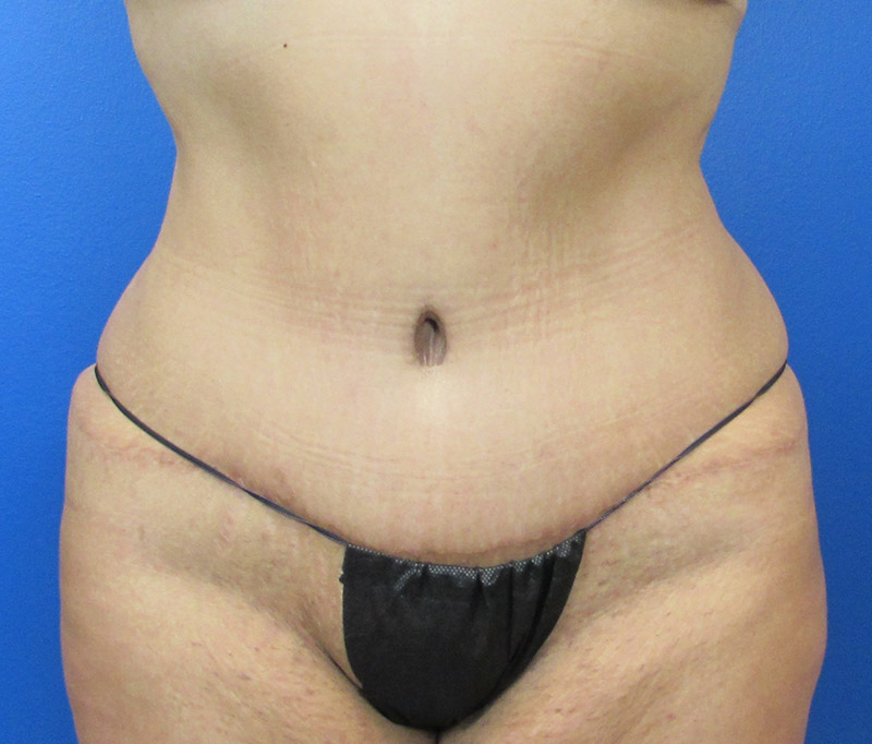 Tummy Tuck Before and After | SGK Plastic Surgery