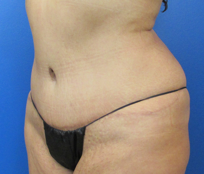 Tummy Tuck Before and After | SGK Plastic Surgery