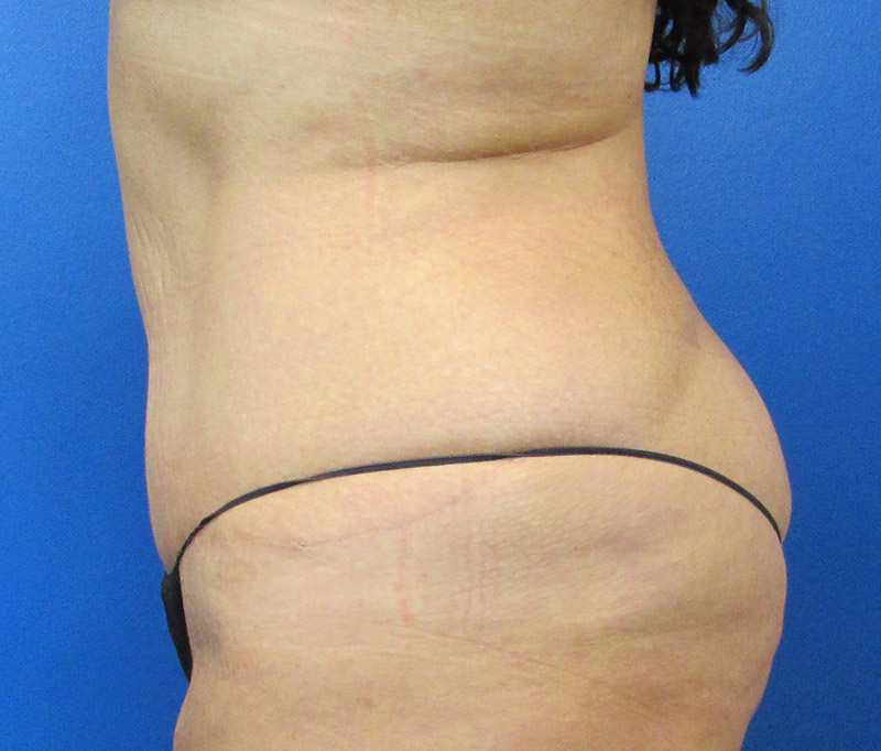 Tummy Tuck Before and After | SGK Plastic Surgery