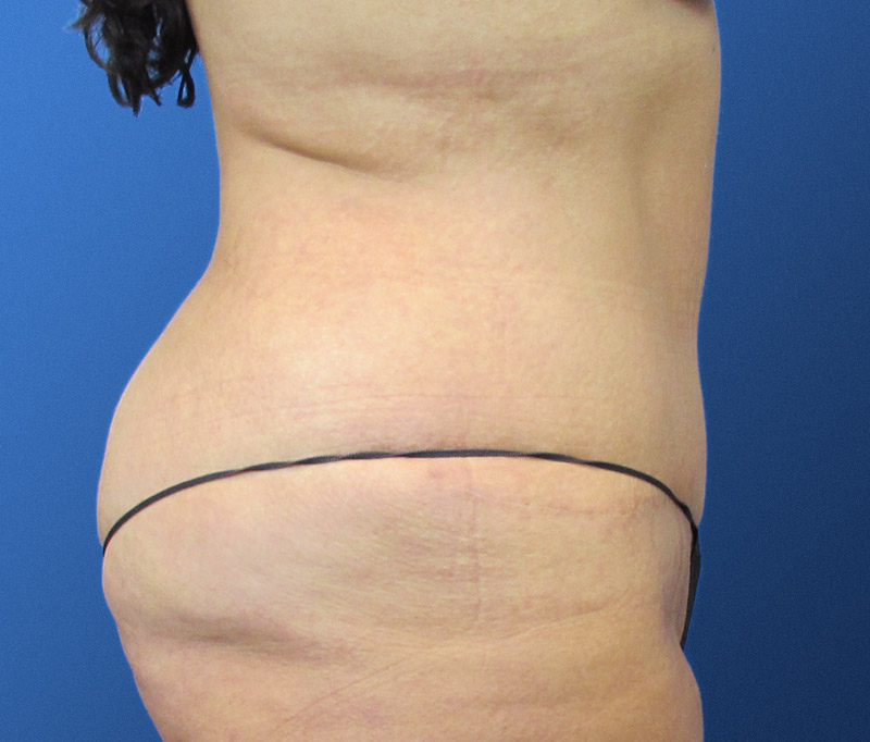 Tummy Tuck Before and After | SGK Plastic Surgery