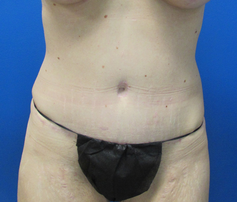 Tummy Tuck Before and After | SGK Plastic Surgery