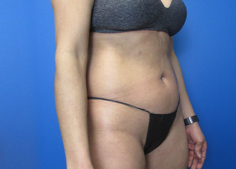 Tummy Tuck Before and After | SGK Plastic Surgery