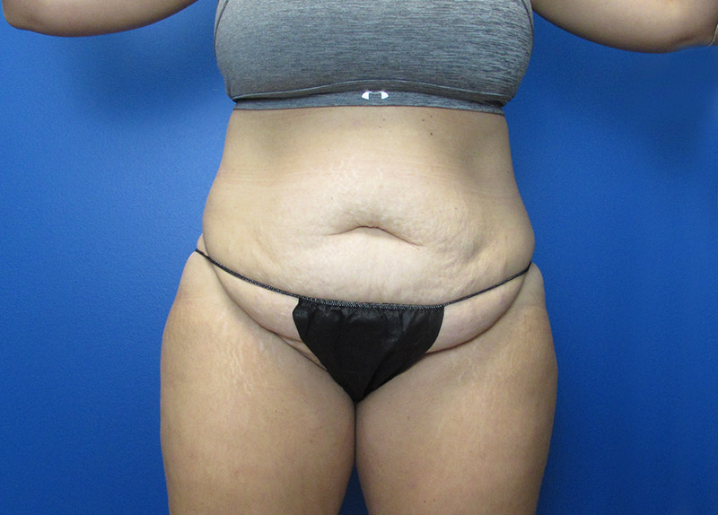 Tummy Tuck Before and After | SGK Plastic Surgery