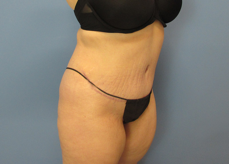 Tummy Tuck Before and After | SGK Plastic Surgery