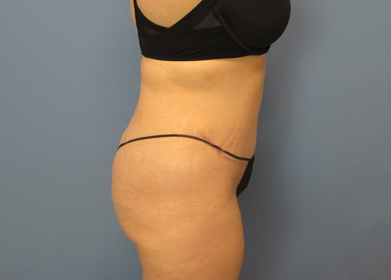 Tummy Tuck Before and After | SGK Plastic Surgery