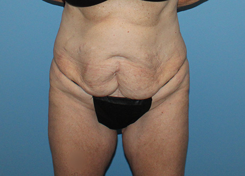 Tummy Tuck Before and After | SGK Plastic Surgery