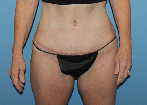 Tummy Tuck Before and After | SGK Plastic Surgery