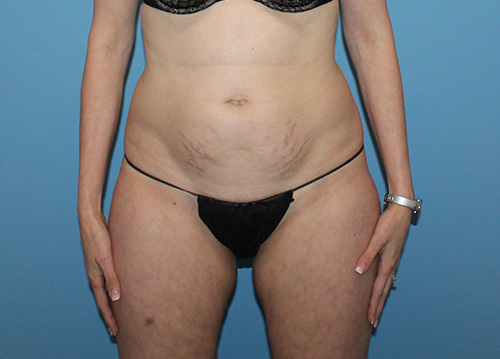 Tummy Tuck Before and After | SGK Plastic Surgery