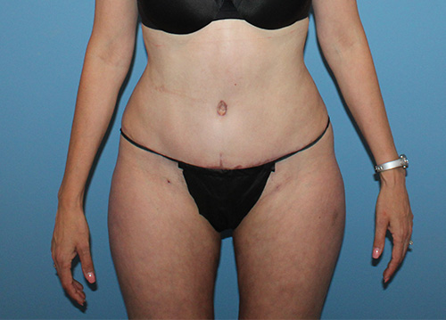 Tummy Tuck Before and After | SGK Plastic Surgery