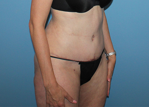 Tummy Tuck Before and After | SGK Plastic Surgery