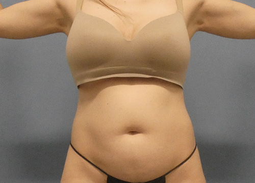 Tummy Tuck Before and After | SGK Plastic Surgery