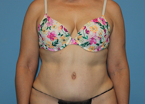 Tummy Tuck Before and After | SGK Plastic Surgery