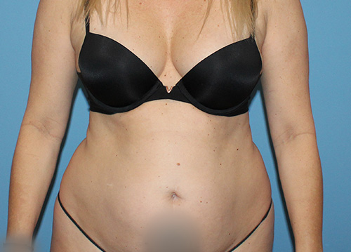 Tummy Tuck Before and After | SGK Plastic Surgery