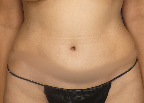 Tummy Tuck Before and After | SGK Plastic Surgery