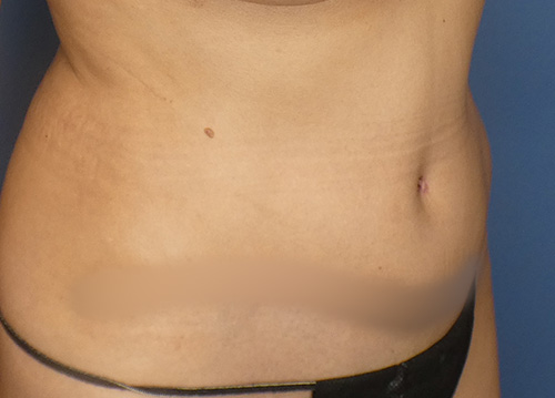 Tummy Tuck Before and After | SGK Plastic Surgery