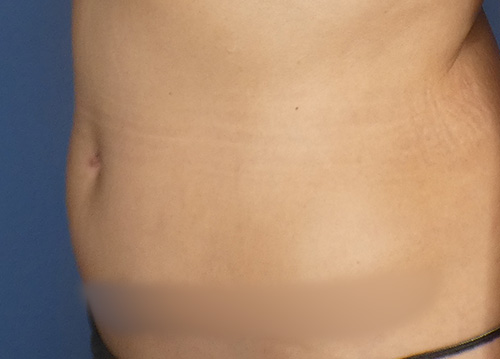 Tummy Tuck Before and After | SGK Plastic Surgery