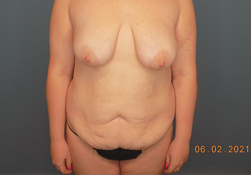 Tummy Tuck Before and After | SGK Plastic Surgery