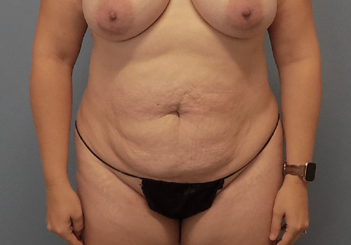 Tummy Tuck Before and After | SGK Plastic Surgery