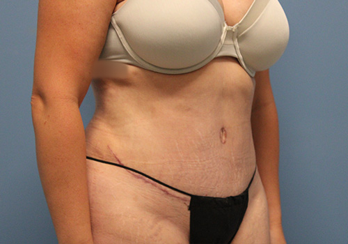 Tummy Tuck Before and After | SGK Plastic Surgery