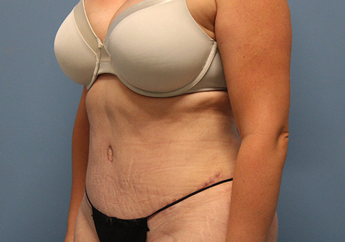 Tummy Tuck Before and After | SGK Plastic Surgery