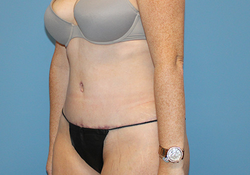 Tummy Tuck Before and After | SGK Plastic Surgery