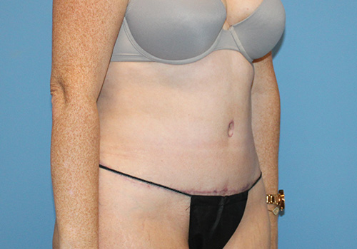 Tummy Tuck Before and After | SGK Plastic Surgery