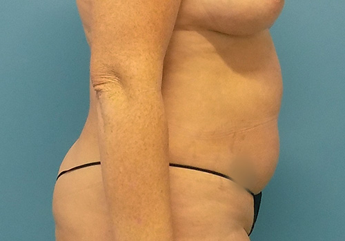 Tummy Tuck Before and After | SGK Plastic Surgery