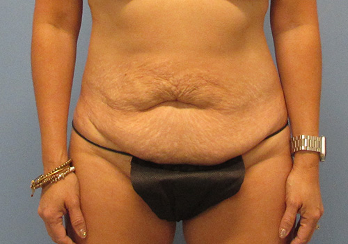 Tummy Tuck Before and After | SGK Plastic Surgery