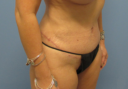 Tummy Tuck Before and After | SGK Plastic Surgery