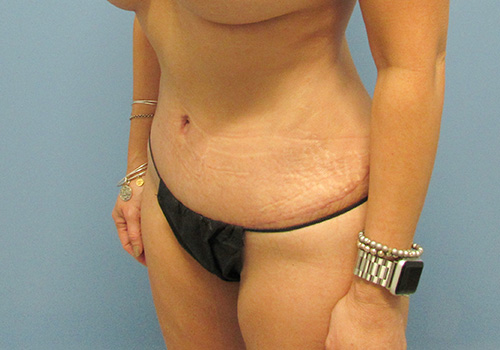 Tummy Tuck Before and After | SGK Plastic Surgery